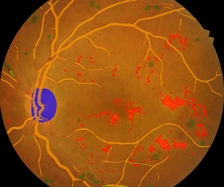 Fundus image - Left Eye