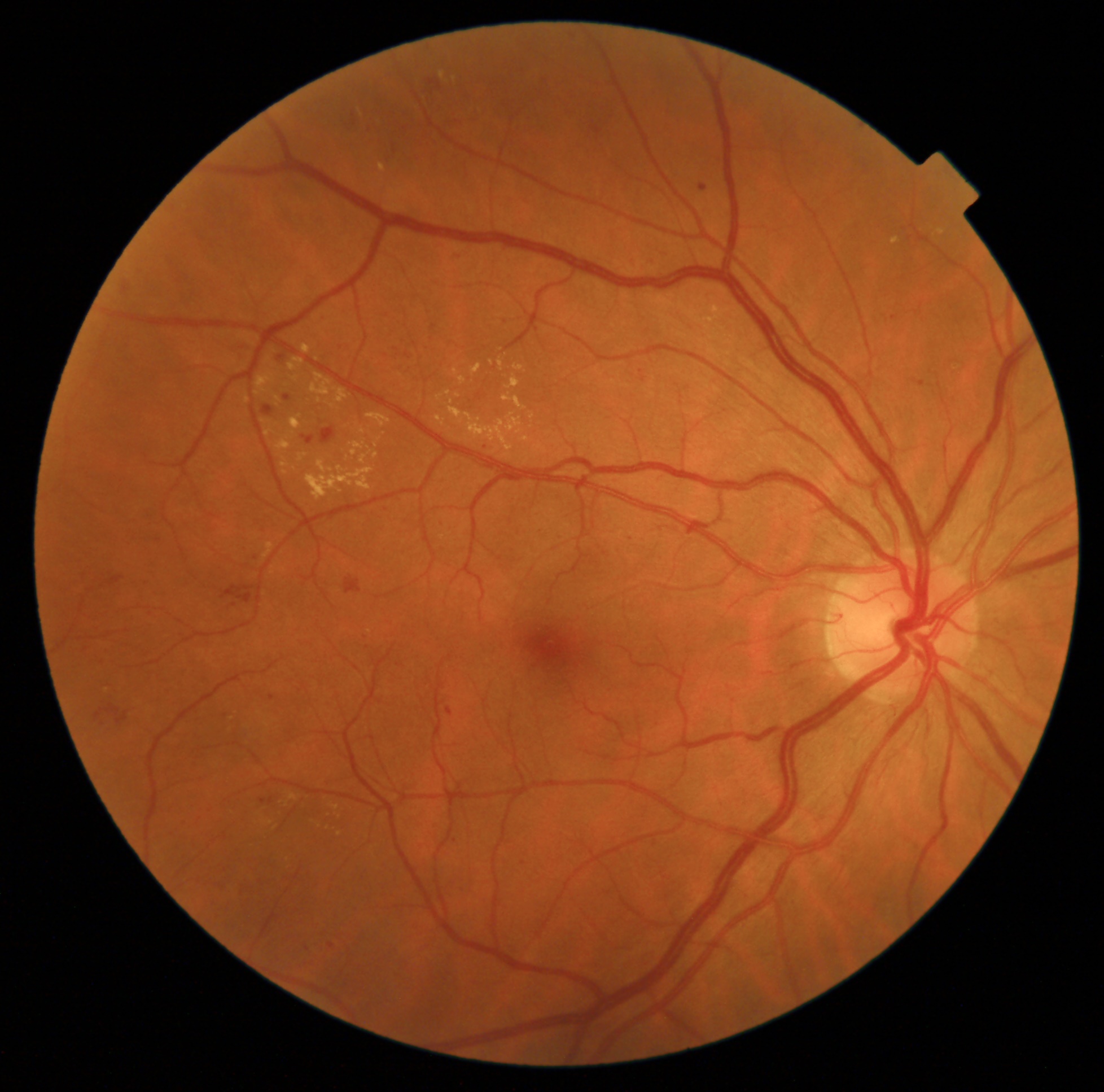 Fundus analysis preview